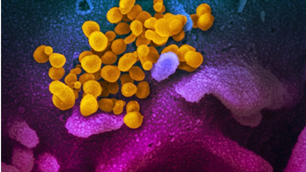 電子顯微鏡下的COVID-19，黃色為病毒，藍色和粉紅色是正常細胞