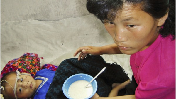 2004年8月4日，在朝鲜平壤南部信阳县医院内，一名营养不良的3岁男孩被喂食联合国世界粮食计划署提供的富含维生素和矿物质的粥