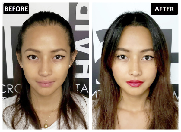 Julienne接受SMP纹发后，成功达致发线前移、秀发健康浓密的效果。（图片来源：客户提供）