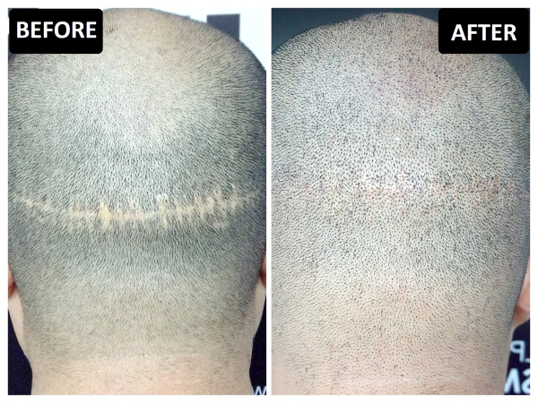 植发手术留大刀疤，摇身变铇头型男（图片来源：客户提供）