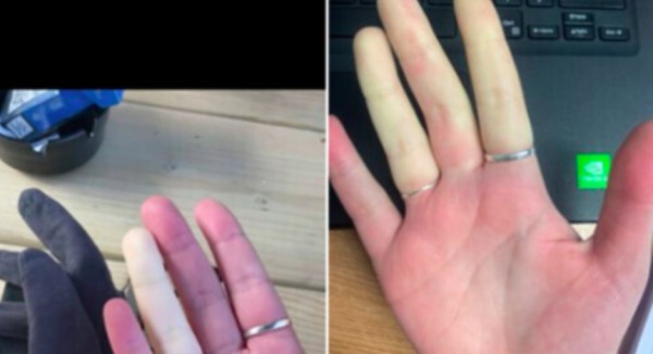 愛爾蘭女子 手指變色 雷洛綜合症