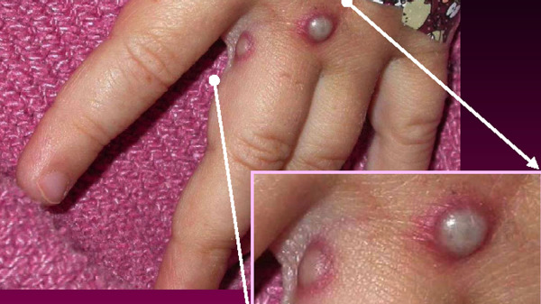 图为2003年，一名感染了猴痘病毒的患者手上所显示的症状