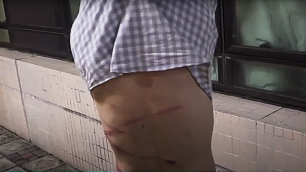 2019年8月29日，钟健平遭人袭击，背部留下多条血痕。（图片来源：视频截图）
