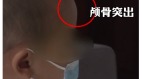 食「特醫奶粉」倍氨敏湖南幼童變大頭娃兒(圖)