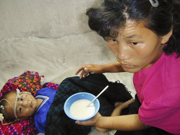 一名营养不良的朝鲜男孩被喂食了一种由联合国世界粮食计划署提供的富含维生素和矿物质的粥。