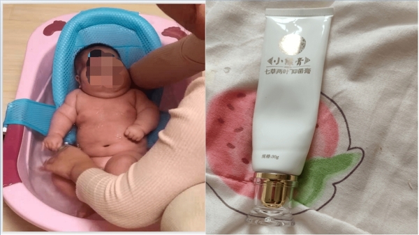 山东青岛近期再度爆出大头娃娃事件，疑似与使用抑菌霜有关（图片来源：微博）
