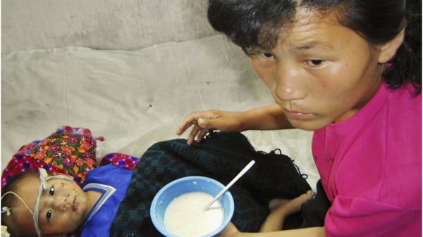 朝鮮營養不良者眾。2004年8月4日，在朝鮮平壤南部信陽縣醫院內，一名營養不良的3歲男孩被餵食聯合國世界糧食計畫署提供的富含維生素和礦物質的粥
