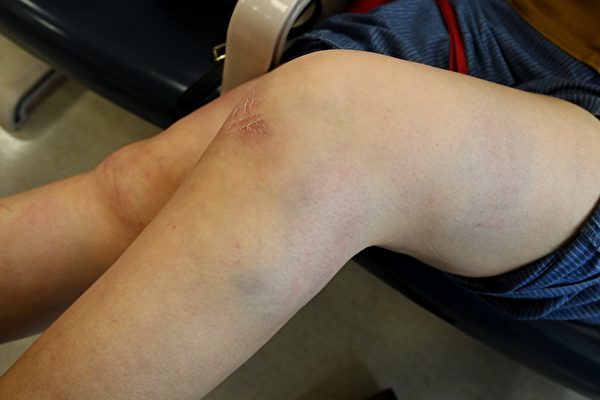 大紀元記者梁珍遇襲後雙腿受傷。（圖片來源：梁珍提供）