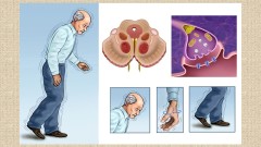 医师：帕金森氏症10大症状中3项要注意了(图)