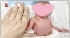 江苏孕妇26周生下“巴掌婴儿”成功存活(图)